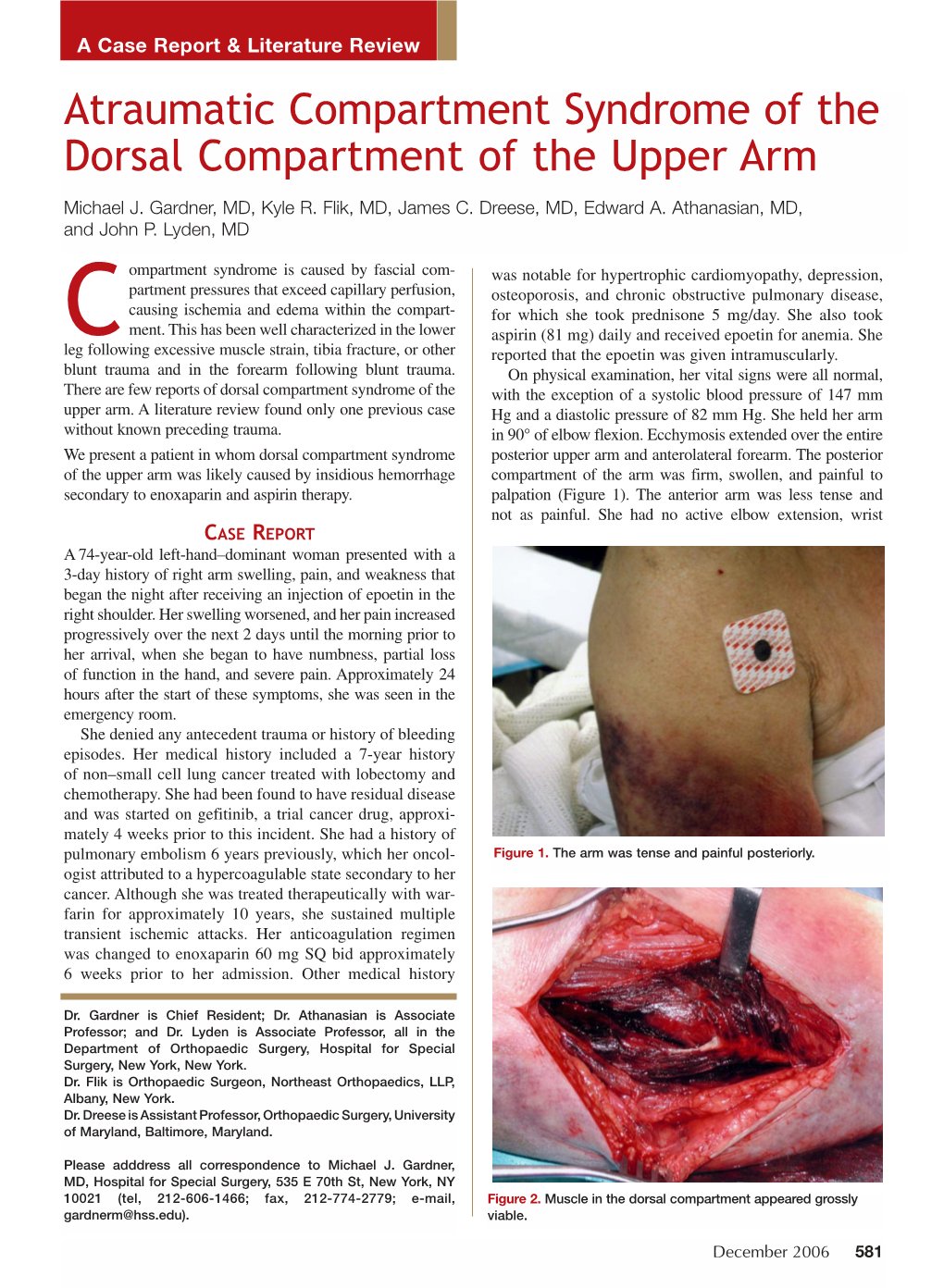 Atraumatic Compartment Syndrome of the Dorsal Compartment of the Upper Arm Michael J