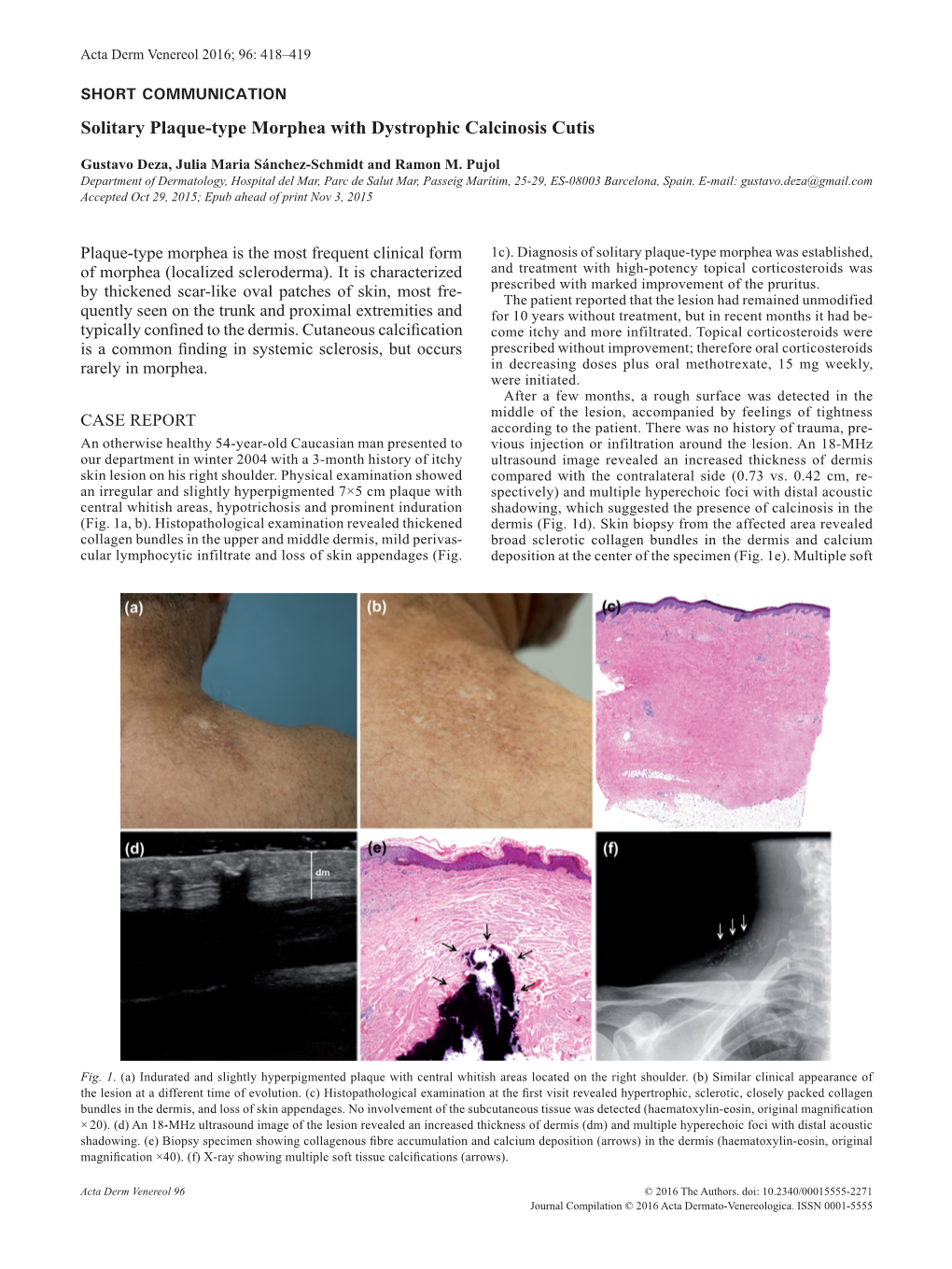 Solitary Plaque-Type Morphea with Dystrophic Calcinosis Cutis