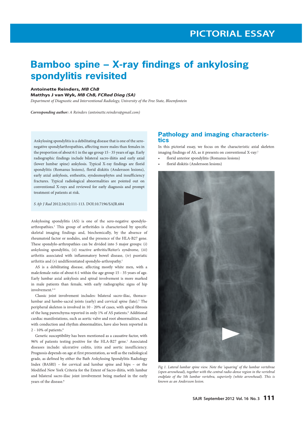 PICTORIAL ESSAY Bamboo Spine – X-Ray Findings of Ankylosing