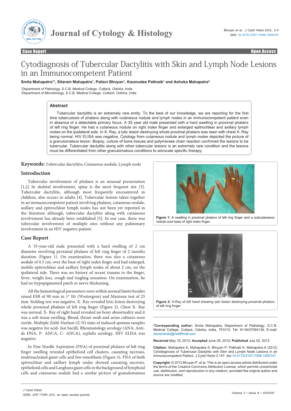 Cytodiagnosis of Tubercular Dactylitis with Skin and Lymph Node Lesions