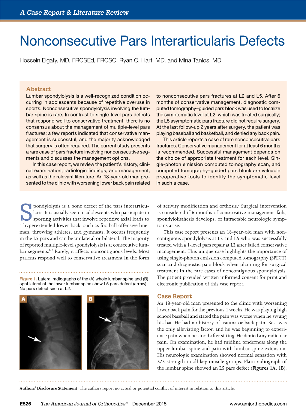 Nonconsecutive Pars Interarticularis Defects