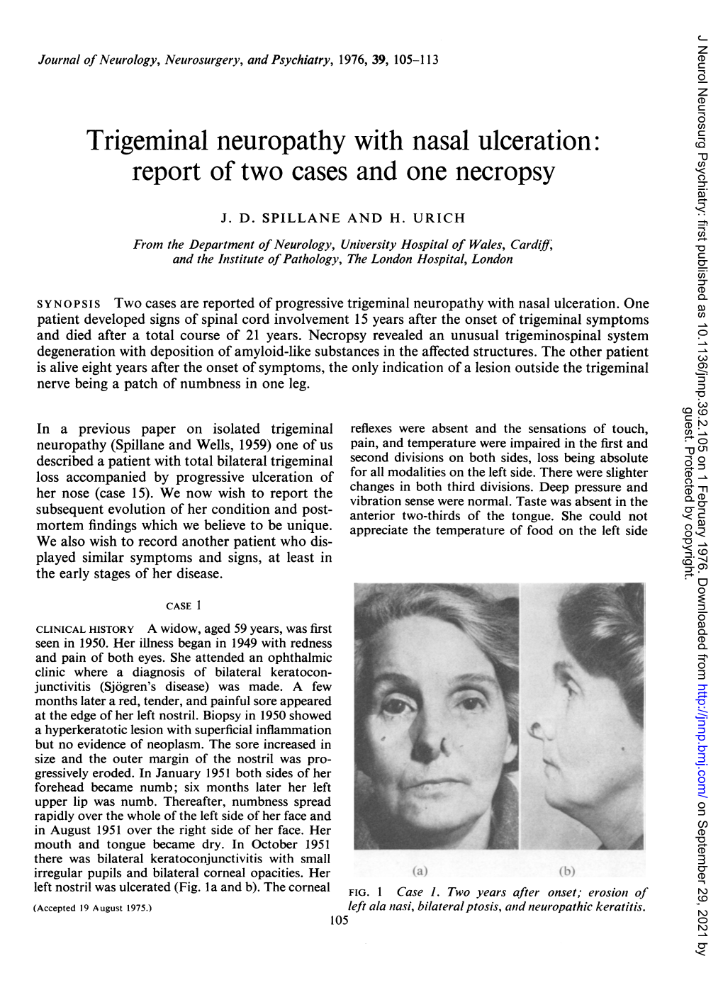 Trigeminal Neuropathy with Nasal Ulceration: Report of Two Cases and One Necropsy