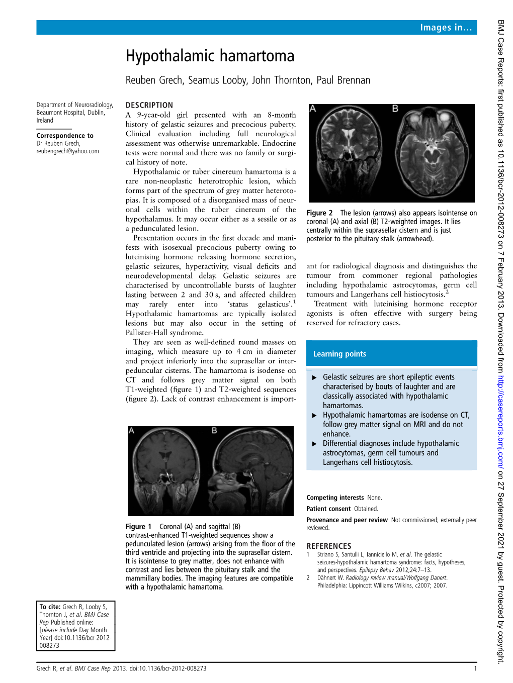 Hypothalamic Hamartoma Reuben Grech, Seamus Looby, John Thornton, Paul Brennan