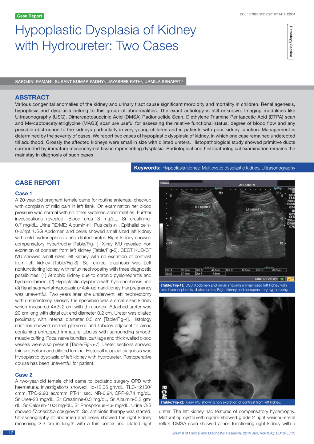 Hypoplastic Dysplasia of Kidney with Hydroureter: Two Cases