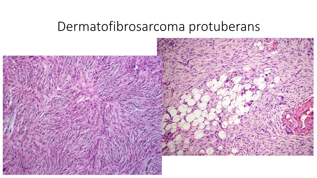 Dermatofibrosarcoma Protuberans Dermatofibrosarcoma Protuberans Storiform Collagenoma