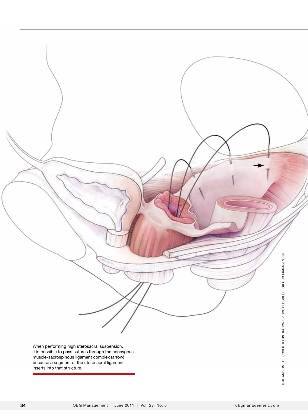 When Performing High Uterosacral Suspension, It Is Possible to Pass Sutures Through the Coccygeus Er: Illustrat Ov