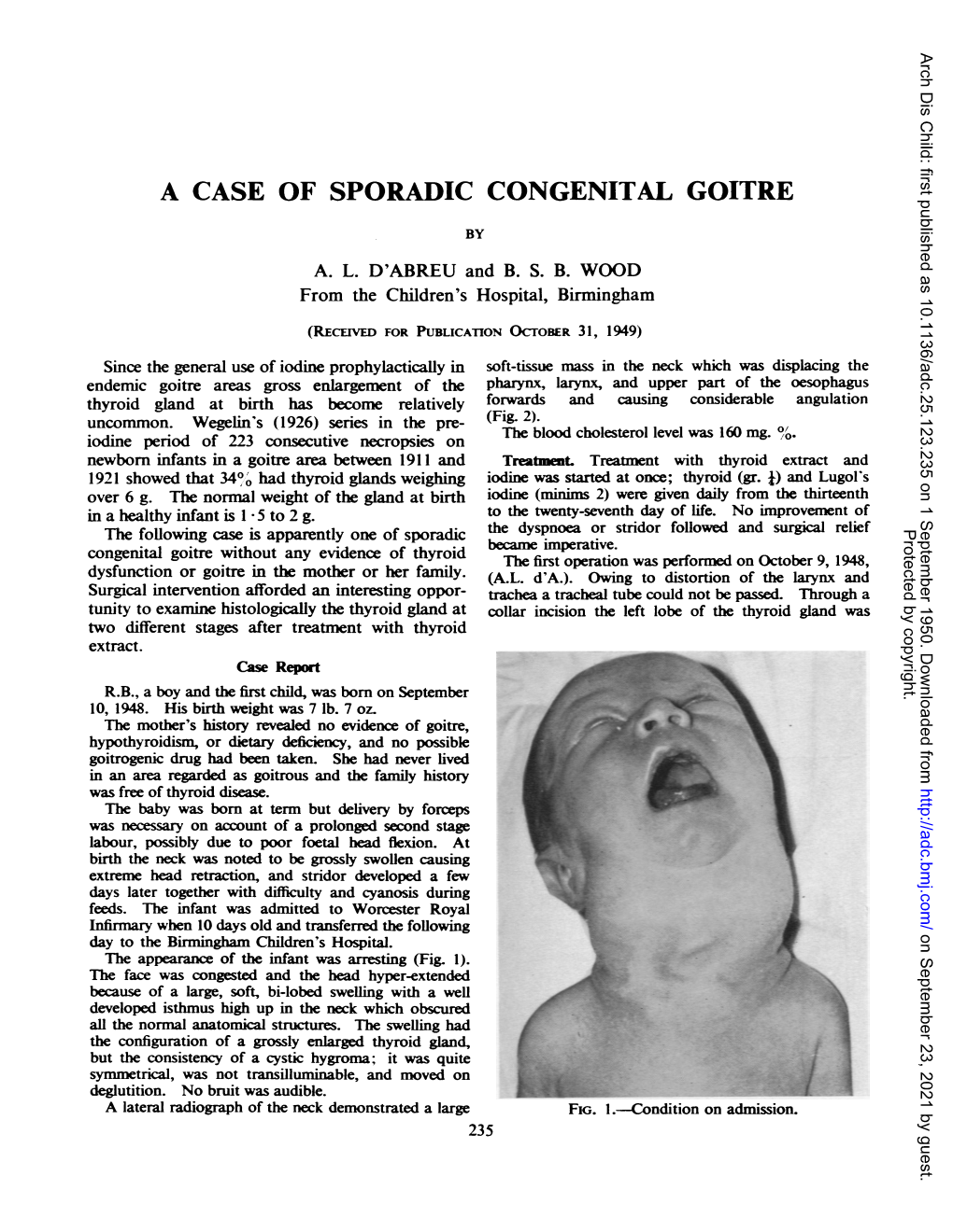 A Case of Sporadic Congenital Goitre