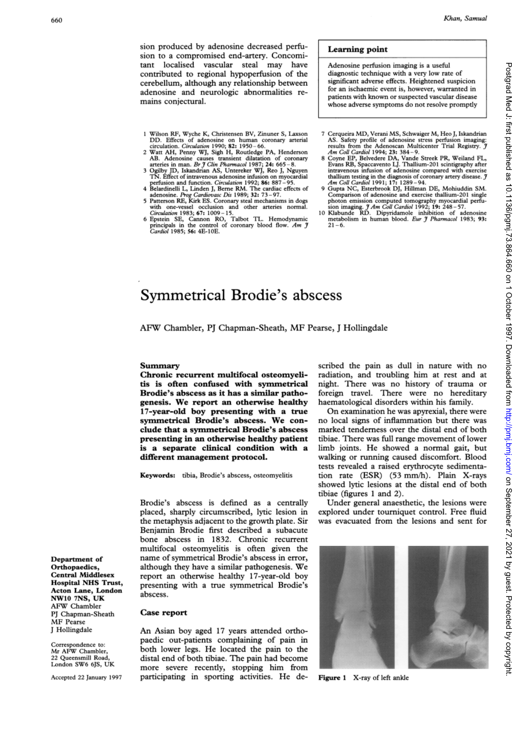 Symmetrical Brodie's Abscess