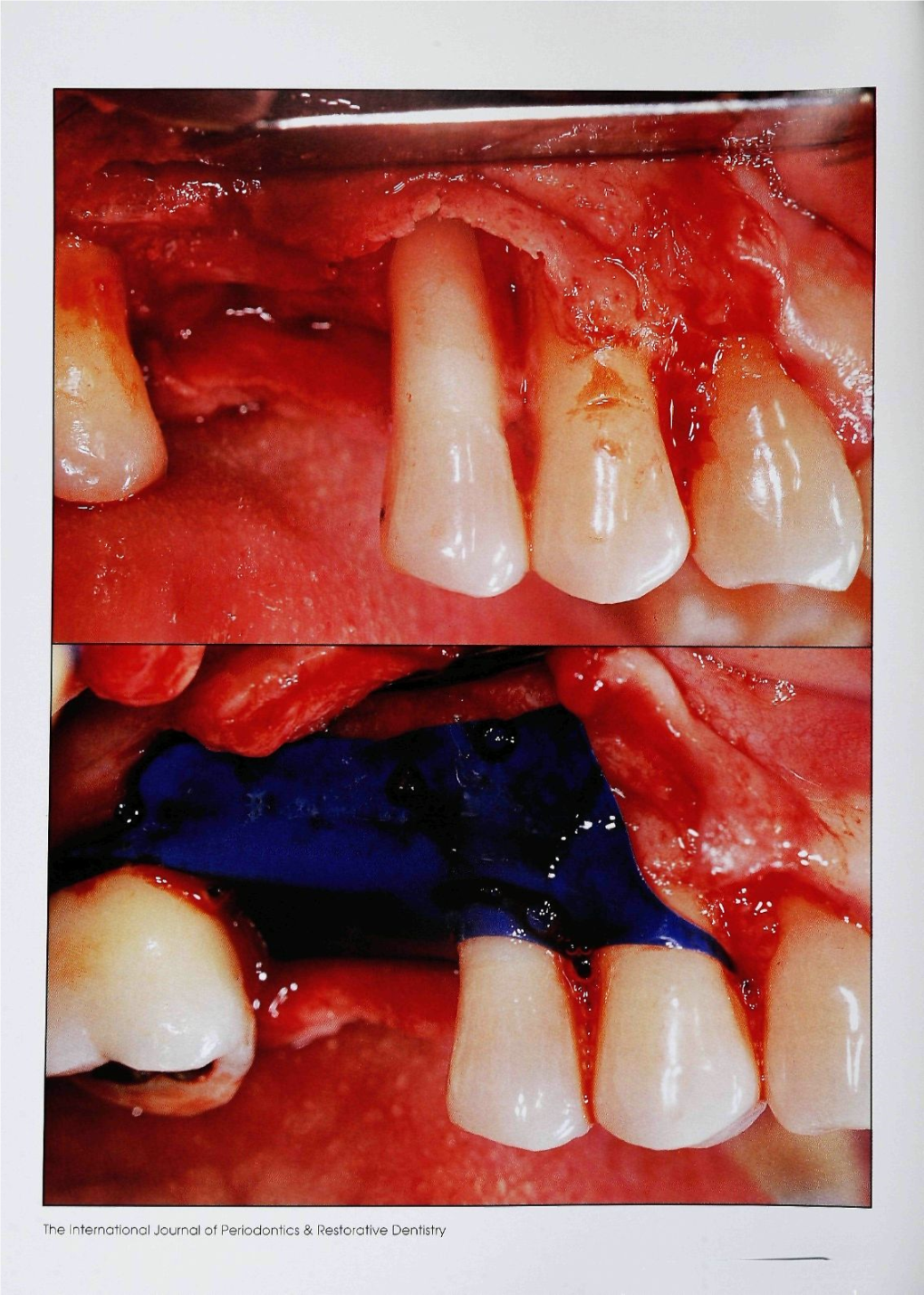 The International Journol of Periodonhcs & Líesloiotive Dentistry