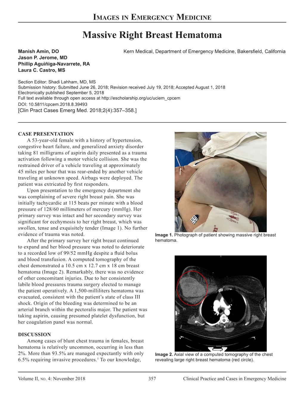 Massive Right Breast Hematoma