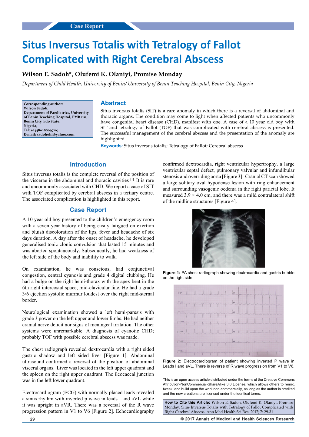 Situs Inversus Totalis with Tetralogy of Fallot Complicated with Right Cerebral Abscess Wilson E