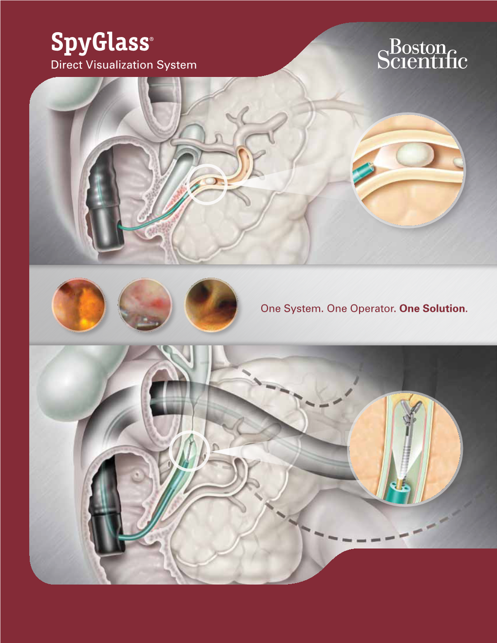 Spyglass® Direct Visualization System