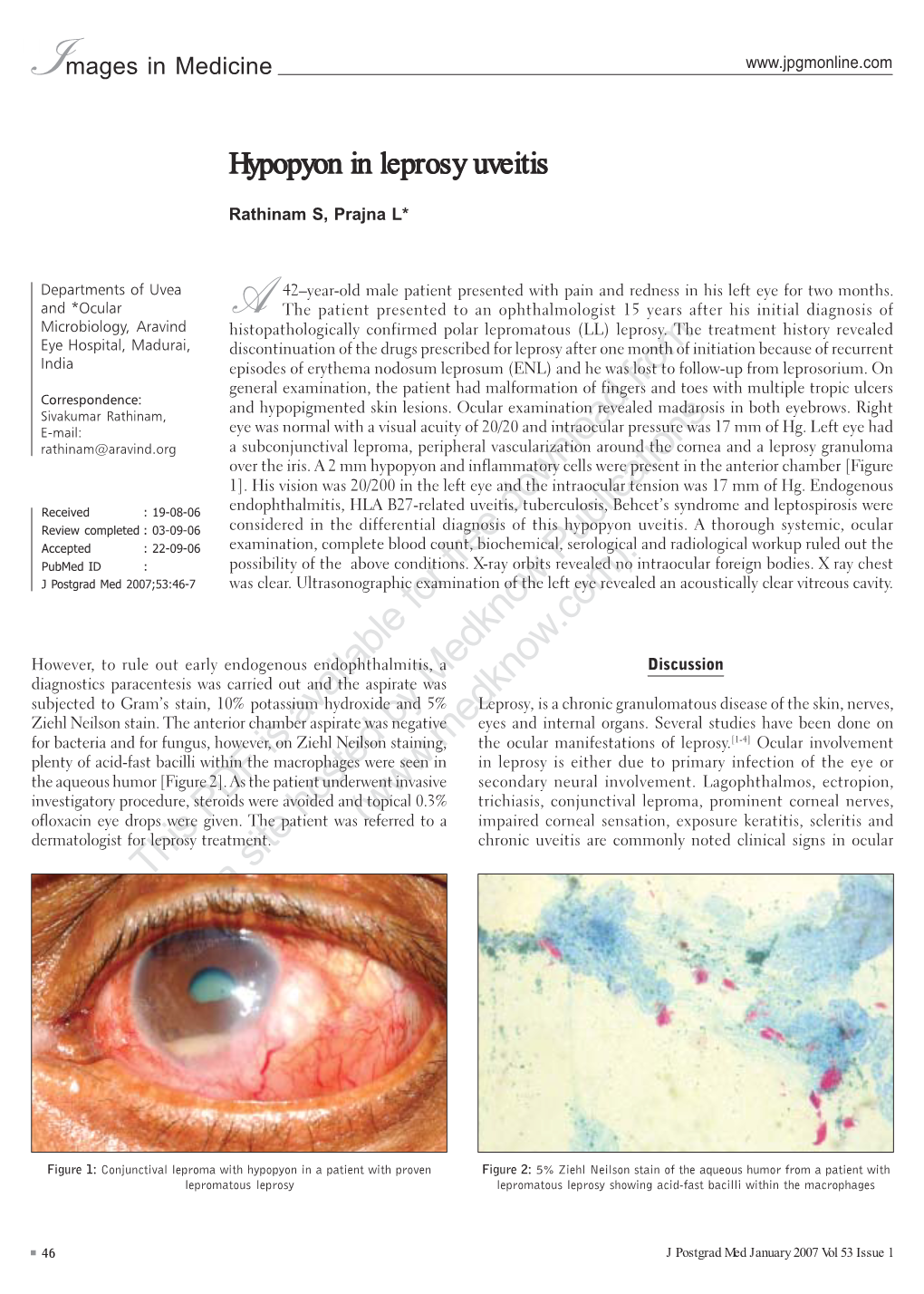 Images in Medicine-Hypopyon in Leprosy Uveitis