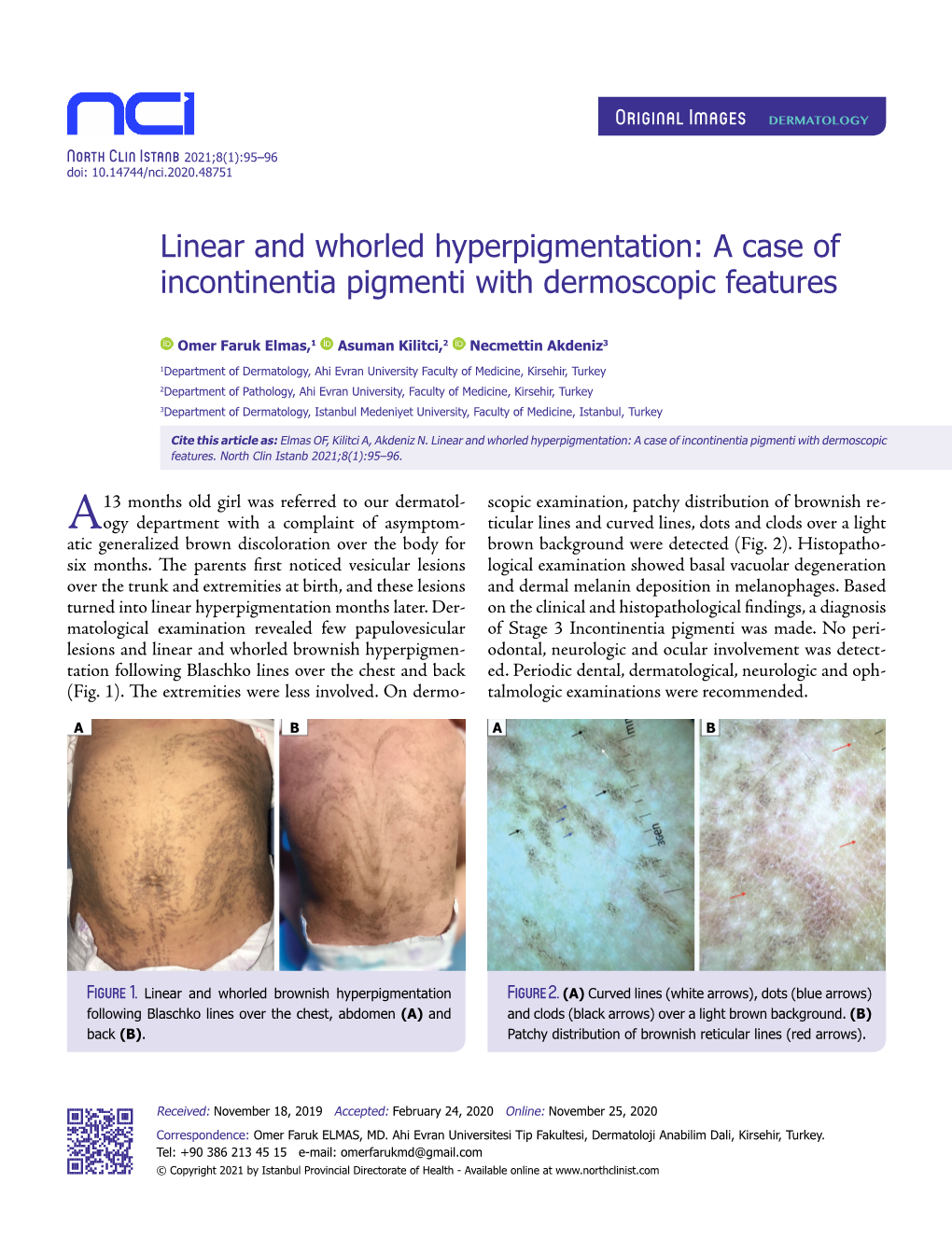 A Case of Incontinentia Pigmenti with Dermoscopic Features