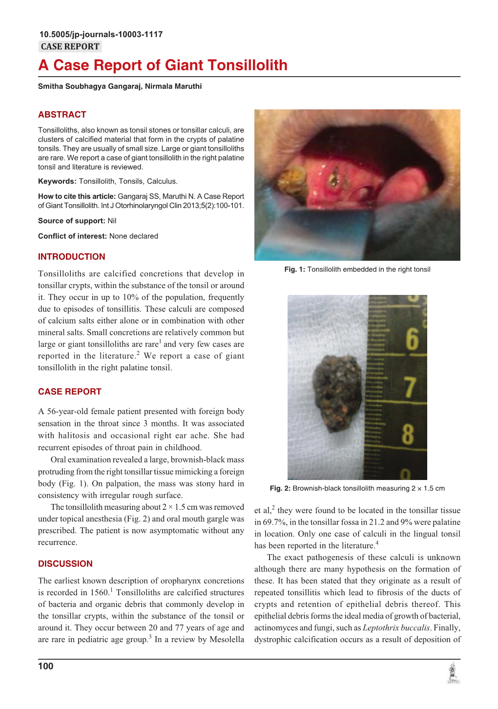 A Case Report of Giant Tonsillolith