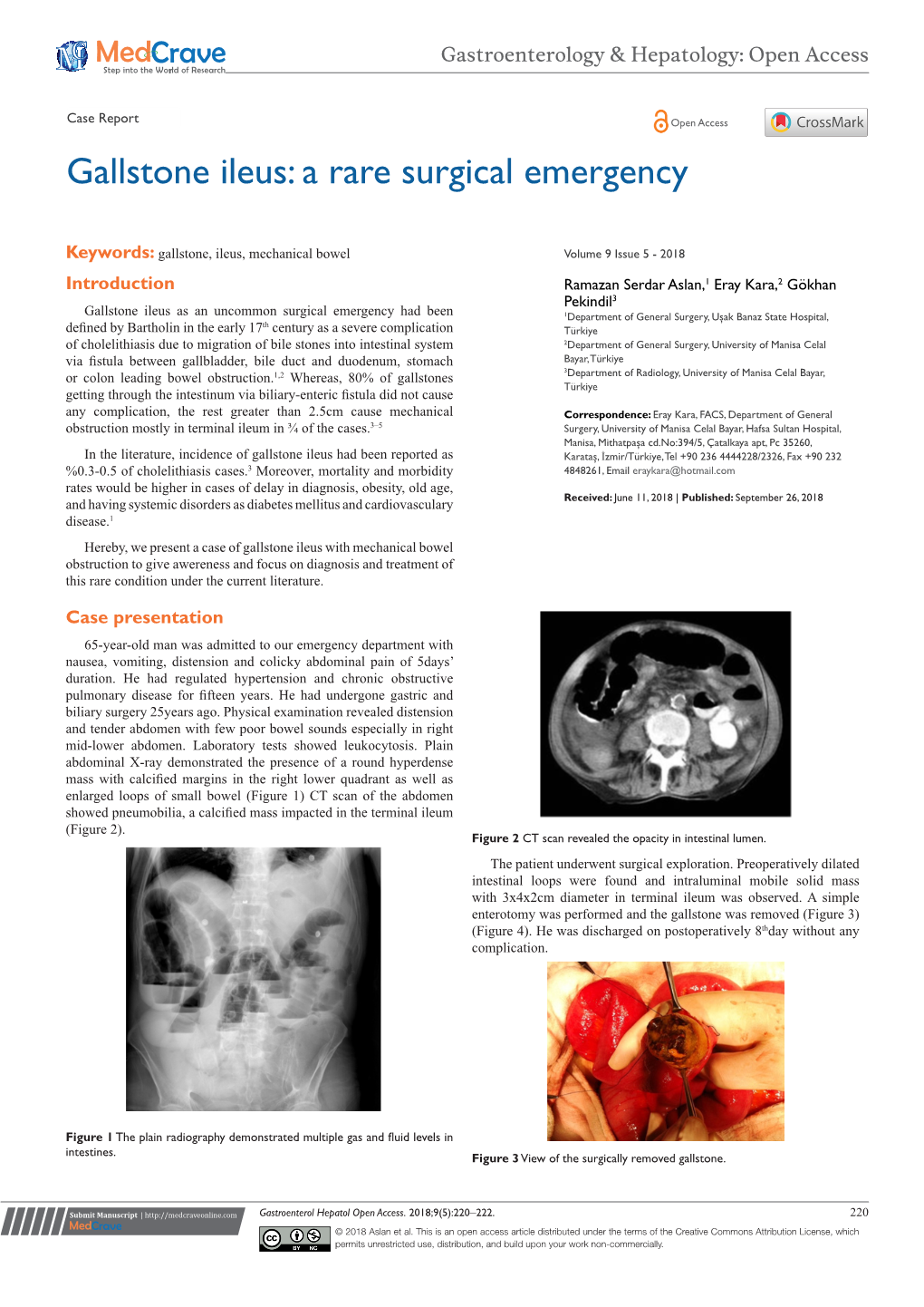 Gallstone Ileus: a Rare Surgical Emergency