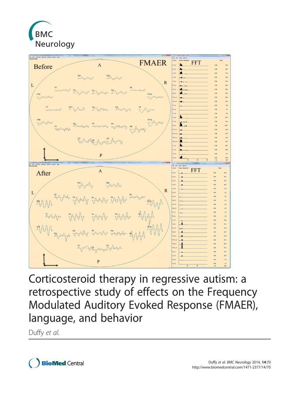 Corticosteroid Therapy in Regressive Autism: a Retrospective Study of Effects on the Frequency Modulated Auditory Evoked Respons