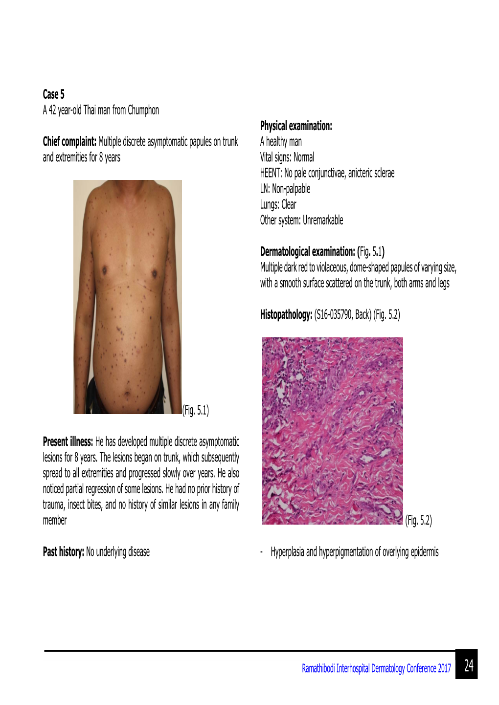 Multiple Discrete Asymptomatic Papules on Trunk and Extremities