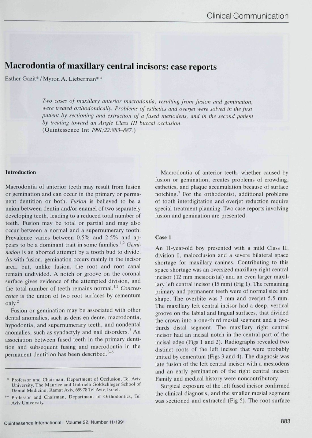 Macrodontia of Maxillary Central Incisors: Case Reports Esther Gazit* / Myroti A