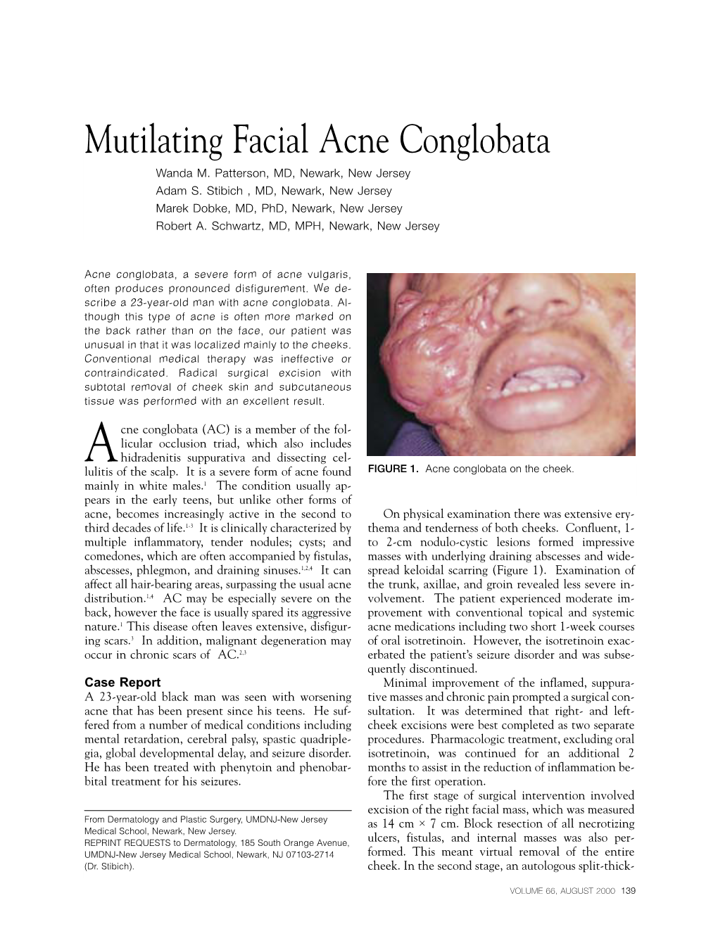 Mutilating Facial Acne Conglobata Wanda M