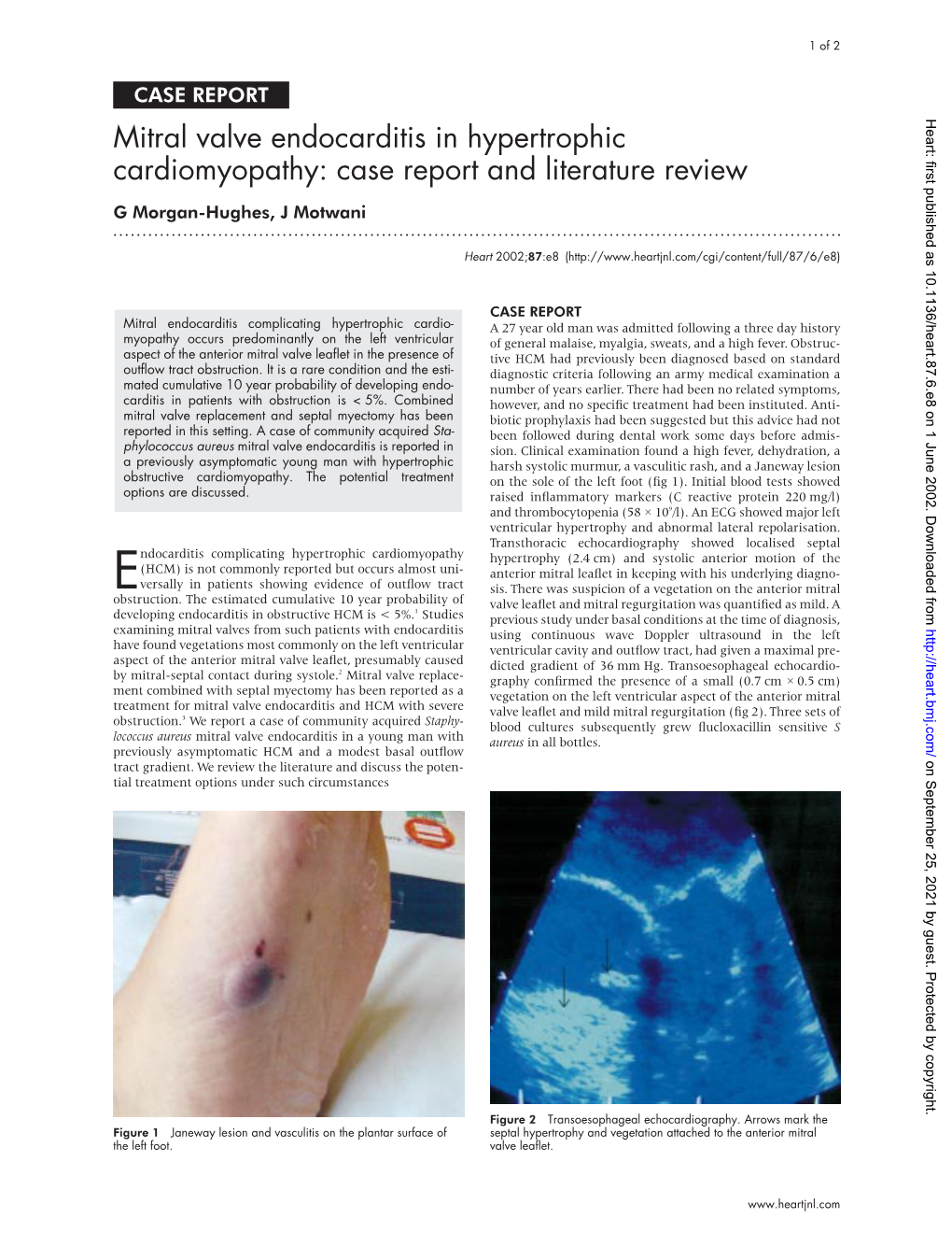 Mitral Valve Endocarditis in Hypertrophic Cardiomyopathy: Case Report and Literature Review G Morgan-Hughes, J Motwani