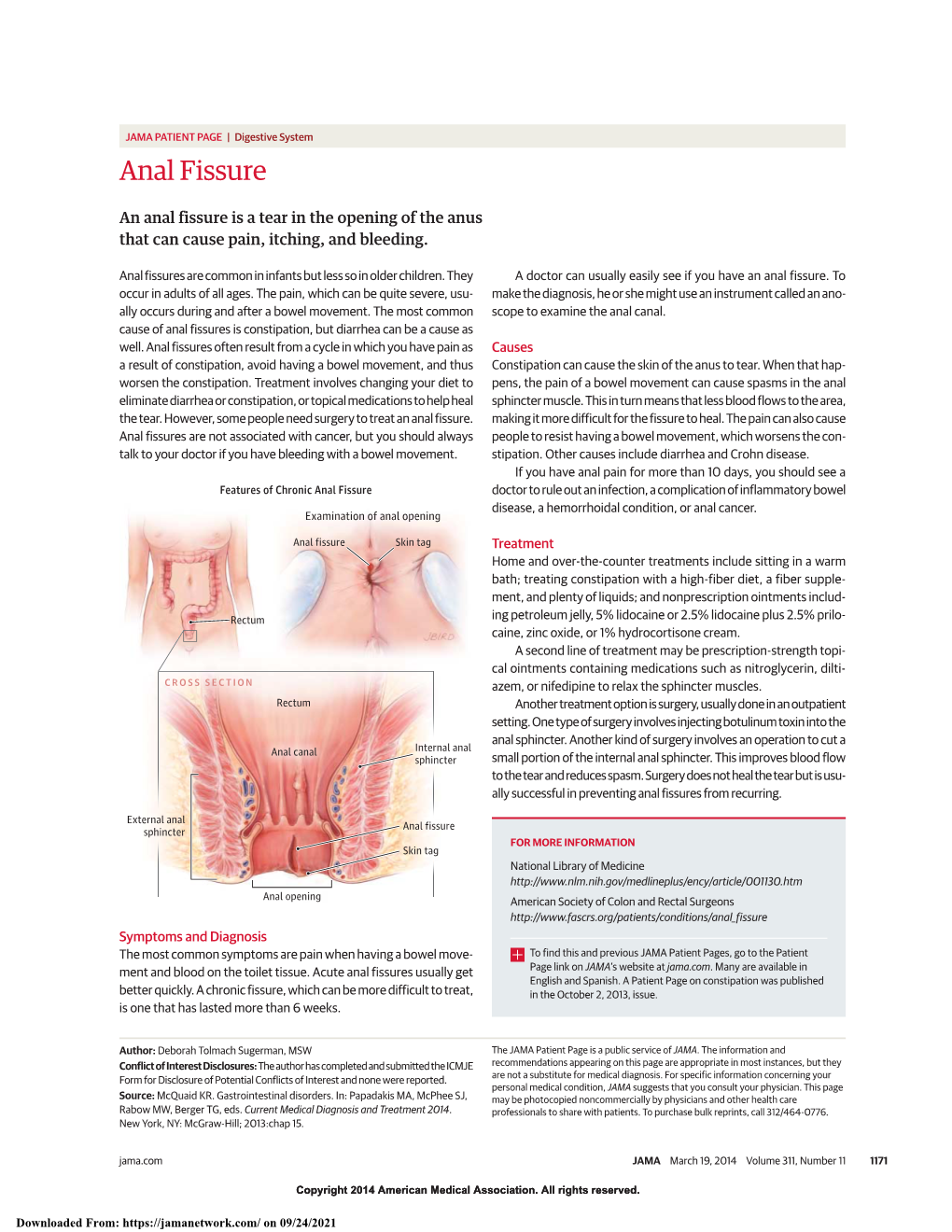 Anal Fissure