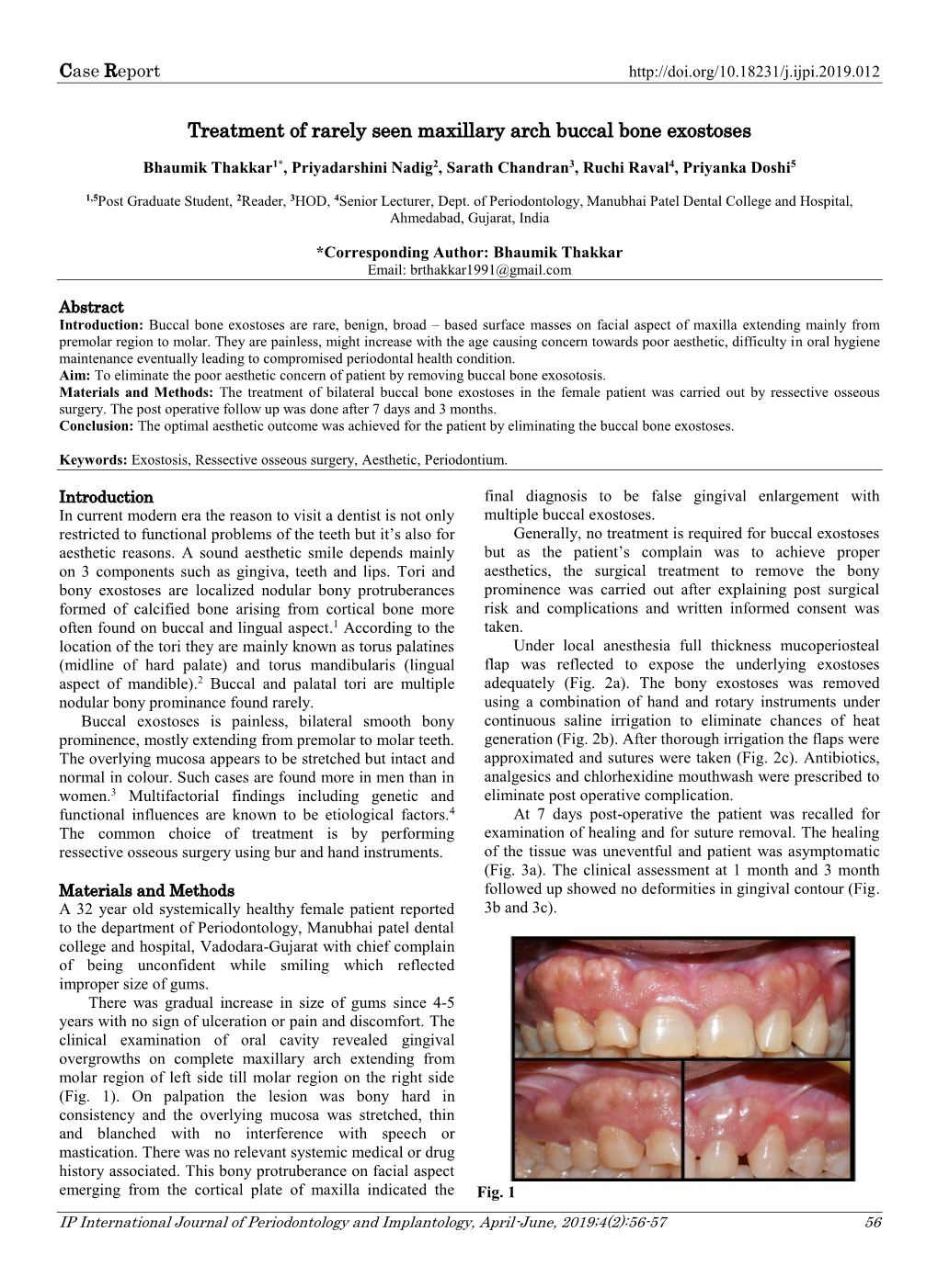 Treatment of Rarely Seen Maxillary Arch Buccal Bone Exostoses