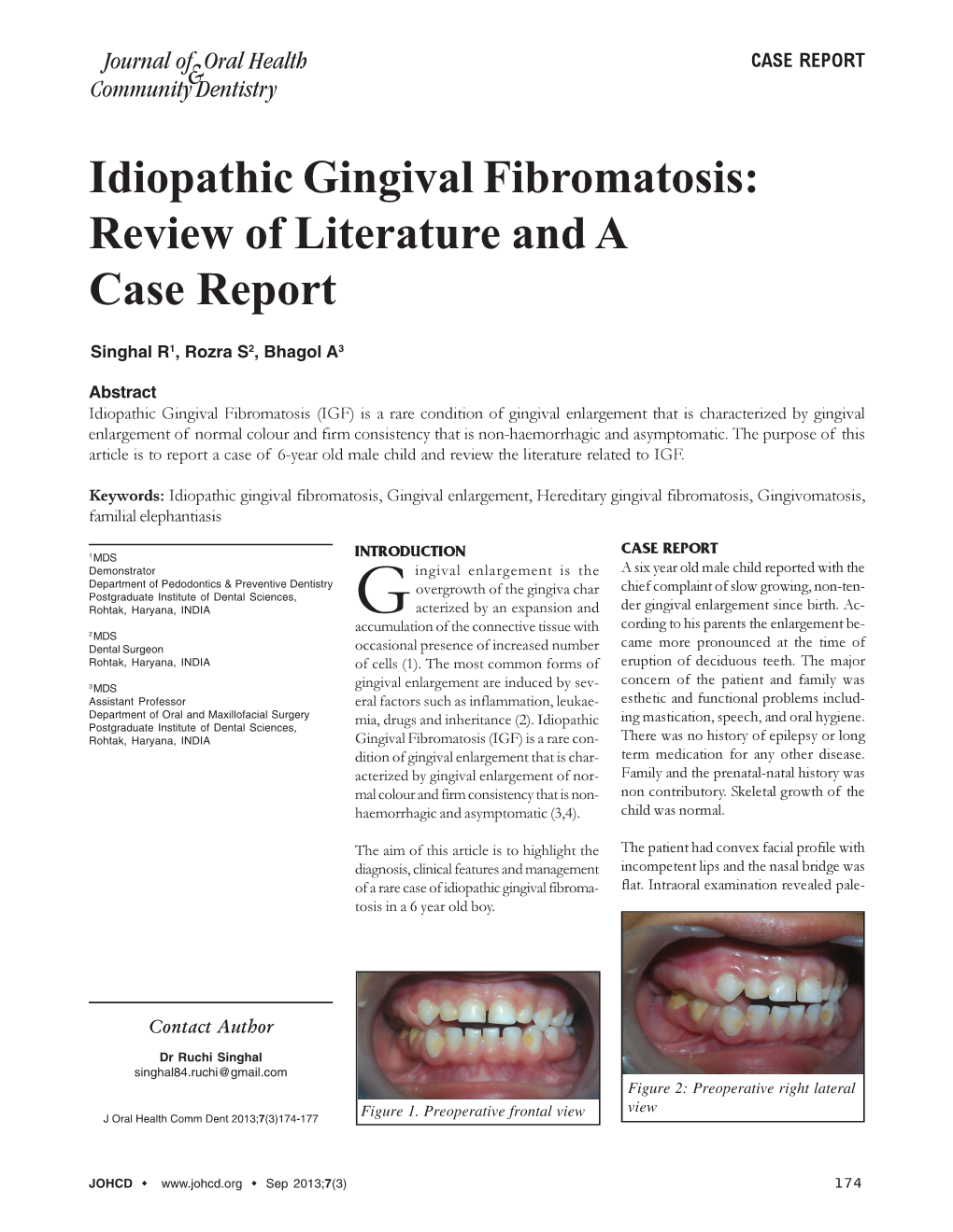 Idiopathic Gingival Fibromatosis: Review of Literature and a Case Report