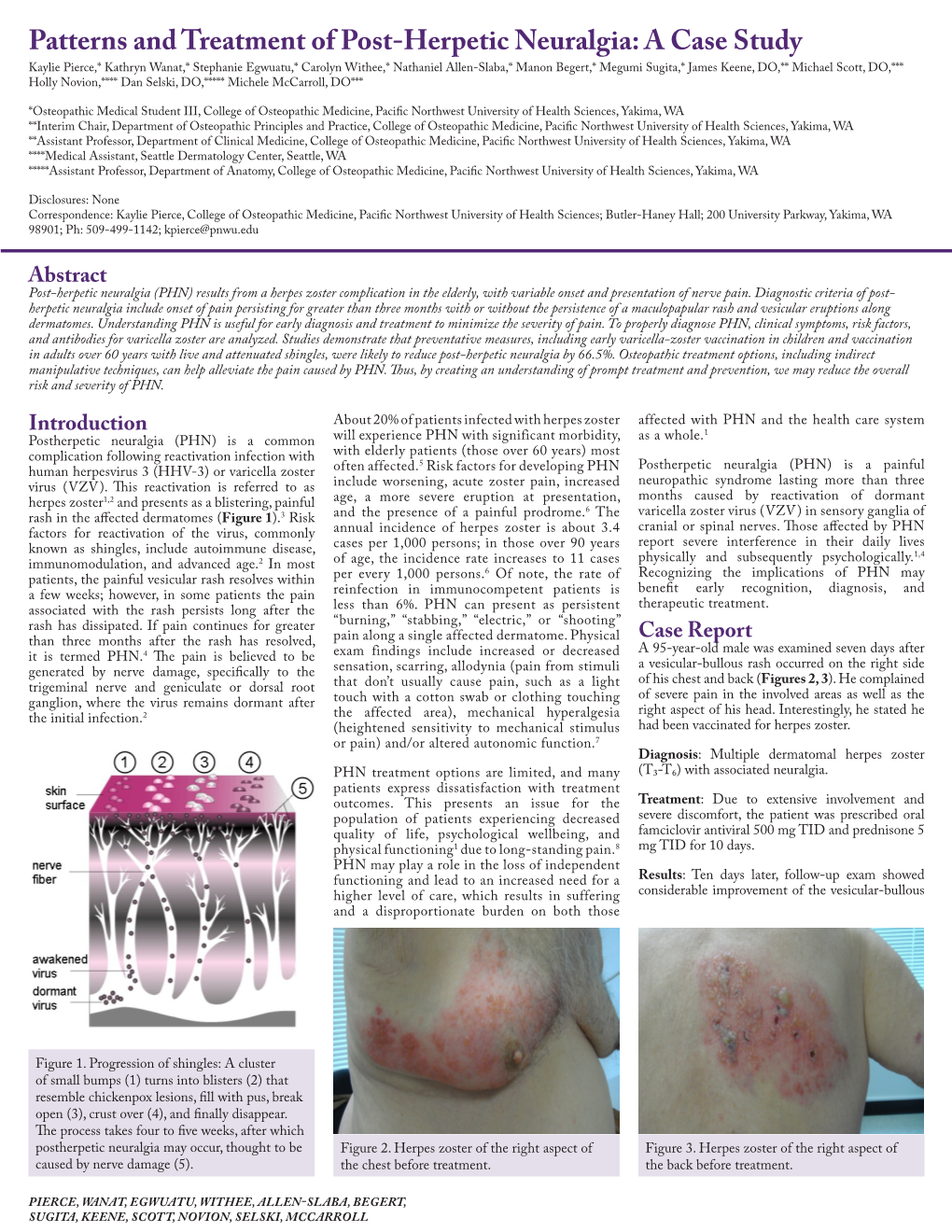 Patterns and Treatment of Post-Herpetic Neuralgia