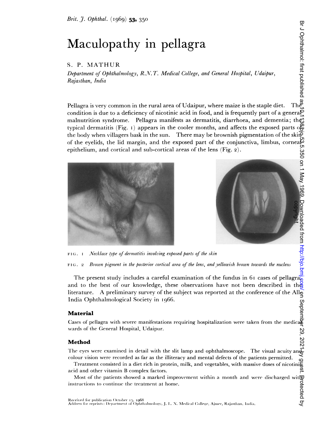 Maculopathy in Pellagra