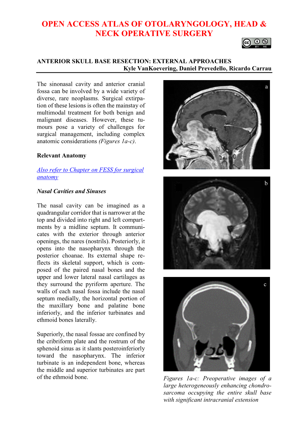 Anterior Skull Base Resection External Approaches