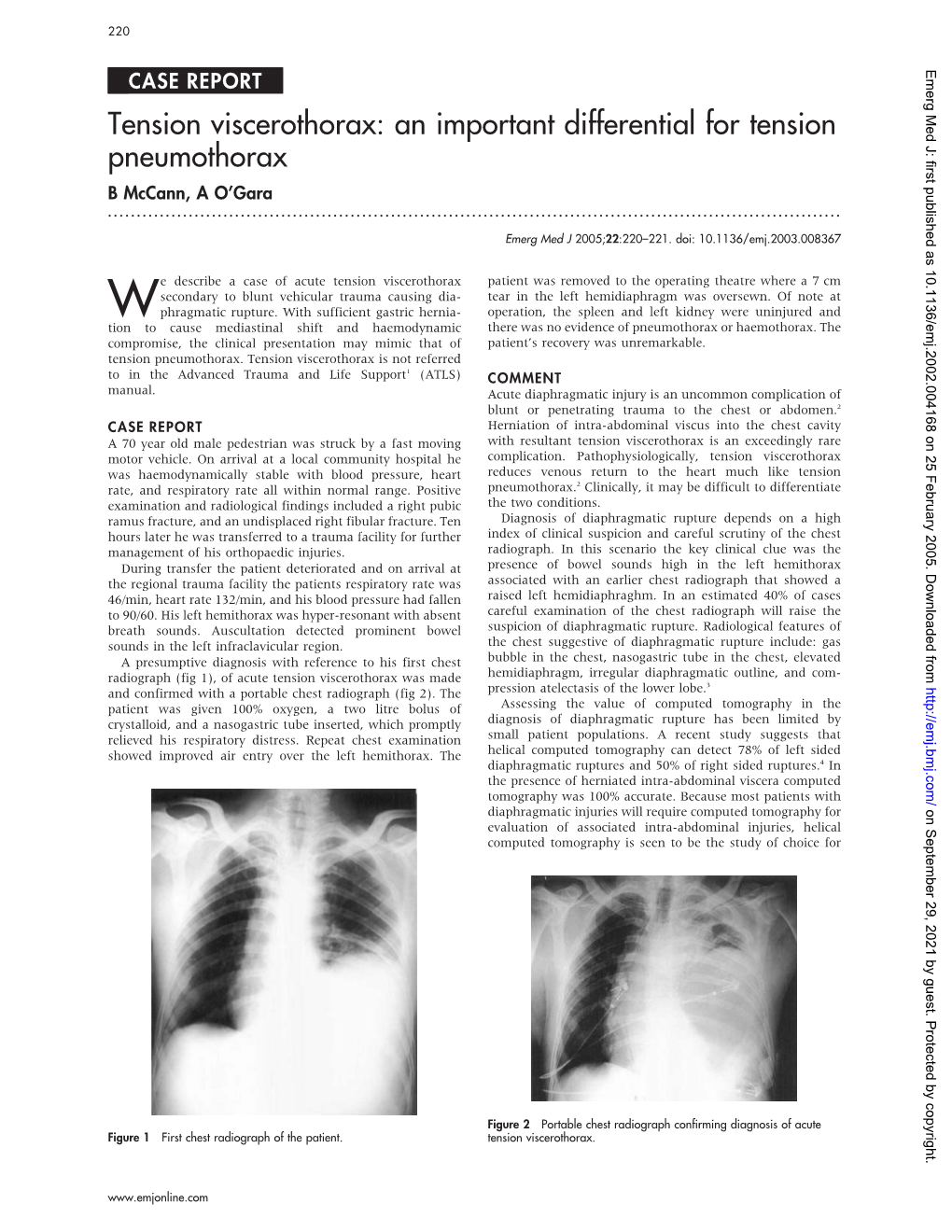 An Important Differential for Tension Pneumothorax B Mccann, a O’Gara