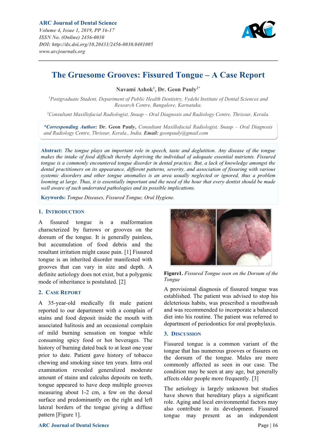 Fissured Tongue – a Case Report
