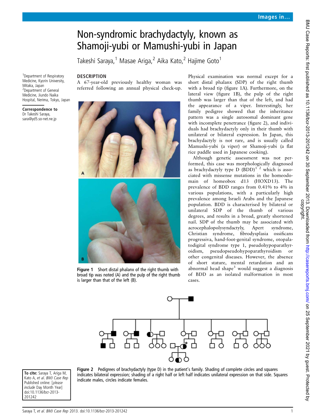 Non-Syndromic Brachydactyly, Known As Shamoji-Yubi Or Mamushi-Yubi in Japan Takeshi Saraya,1 Masae Ariga,2 Aika Kato,2 Hajime Goto1