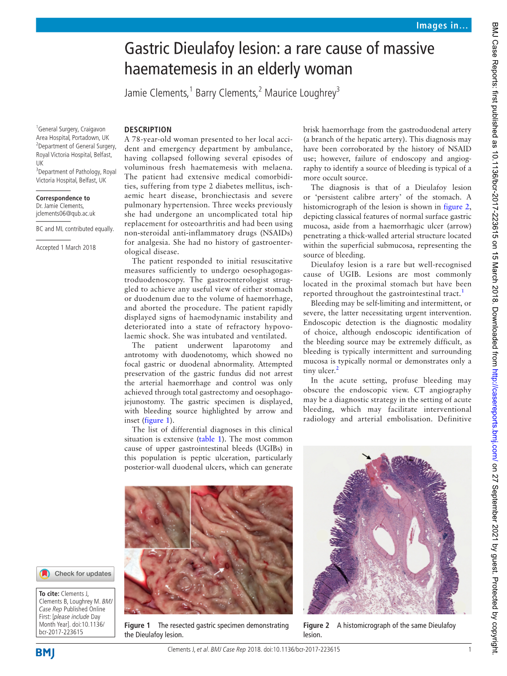 Gastric Dieulafoy Lesion: a Rare Cause of Massive Haematemesis in an Elderly Woman Jamie Clements,1 Barry Clements,2 Maurice Loughrey3