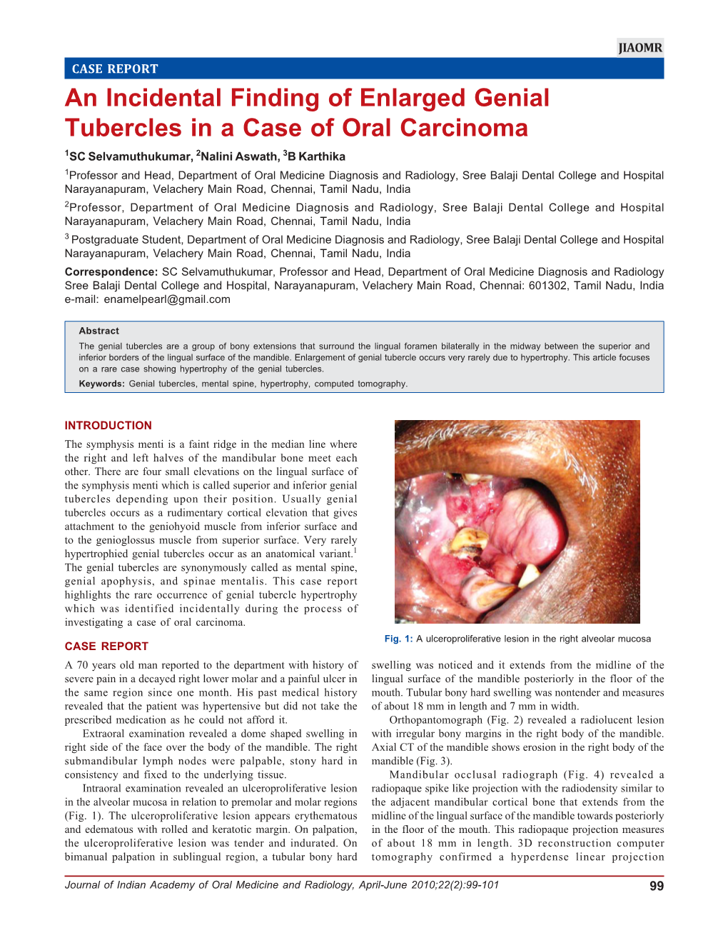 An Incidental Finding of Enlarged Genial Tubercles in a Case of Oral