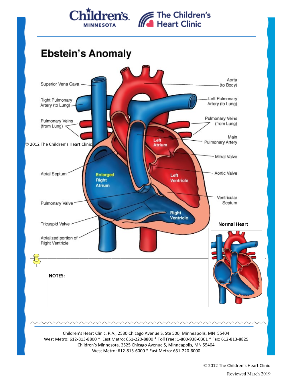 Ebstein's Anomaly