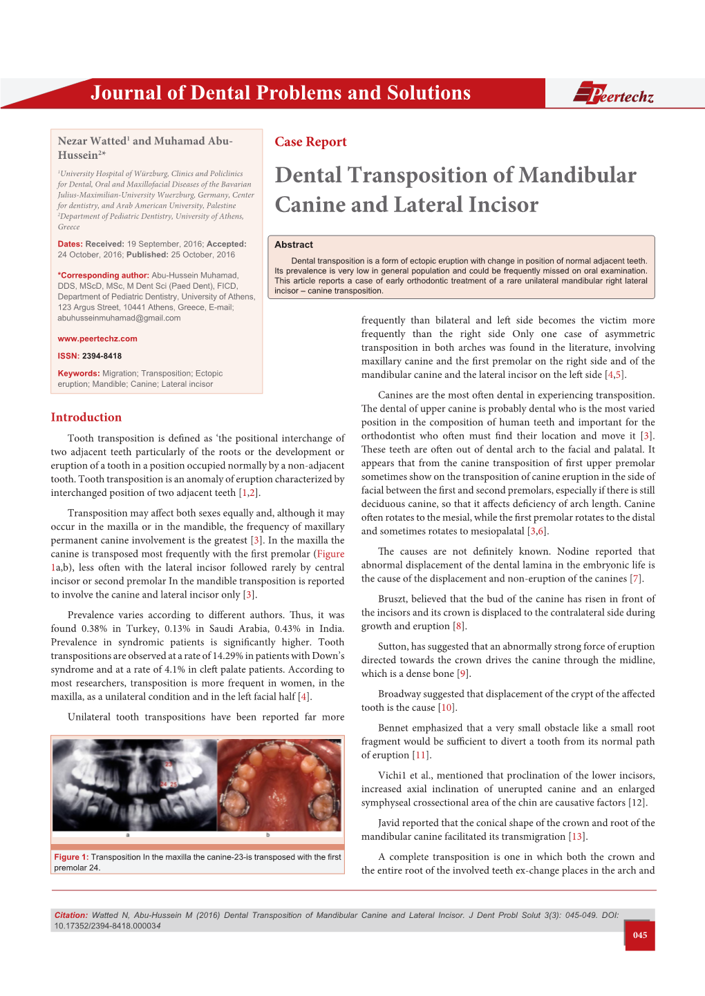 Dental Transposition of Mandibular Canine and Lateral Incisor