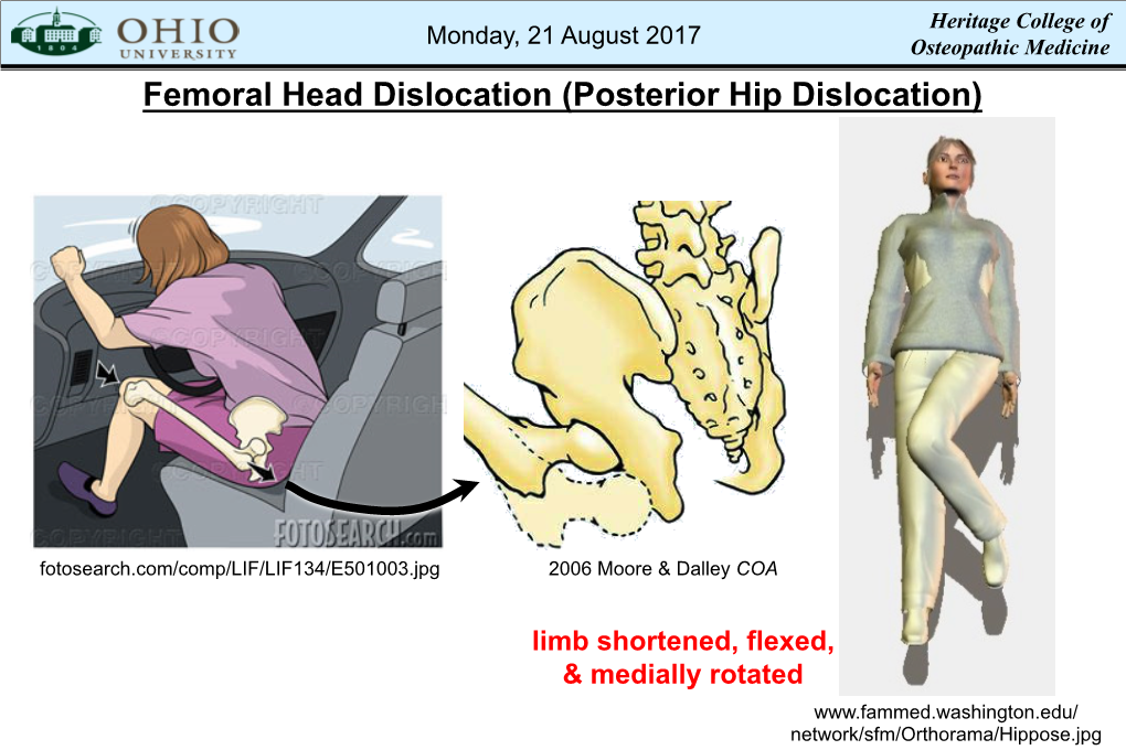 Femoral Head Dislocation (Posterior Hip Dislocation)