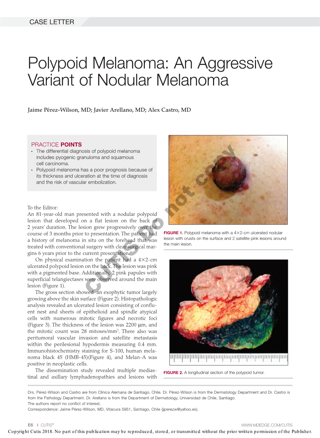 Polypoid Melanoma: an Aggressive Variant of Nodular Melanoma