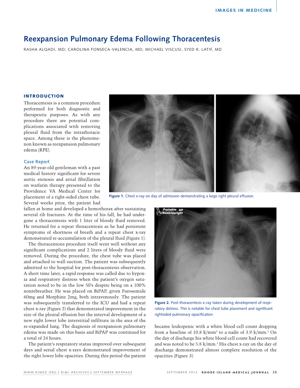 Reexpansion Pulmonary Edema Following Thoracentesis