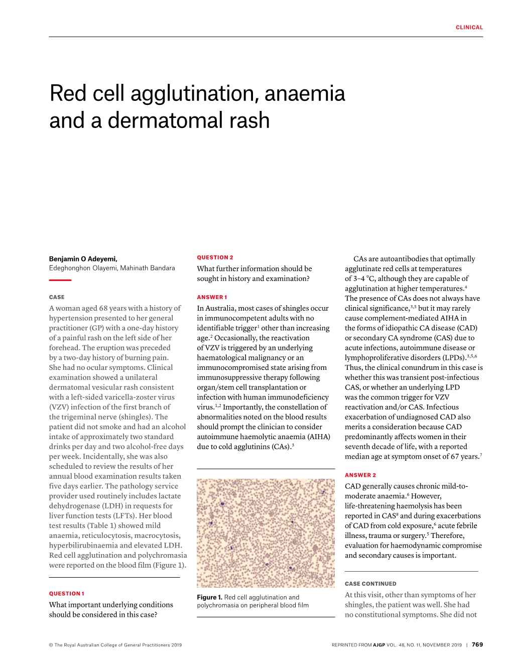 Red Cell Agglutination, Anaemia and a Dermatomal Rash