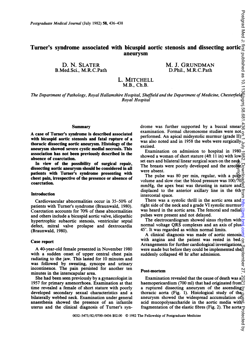 Turner's Syndrome Associated with Bicuspid Aortic Stenosis and Dissecting Aortic Aneurysm D