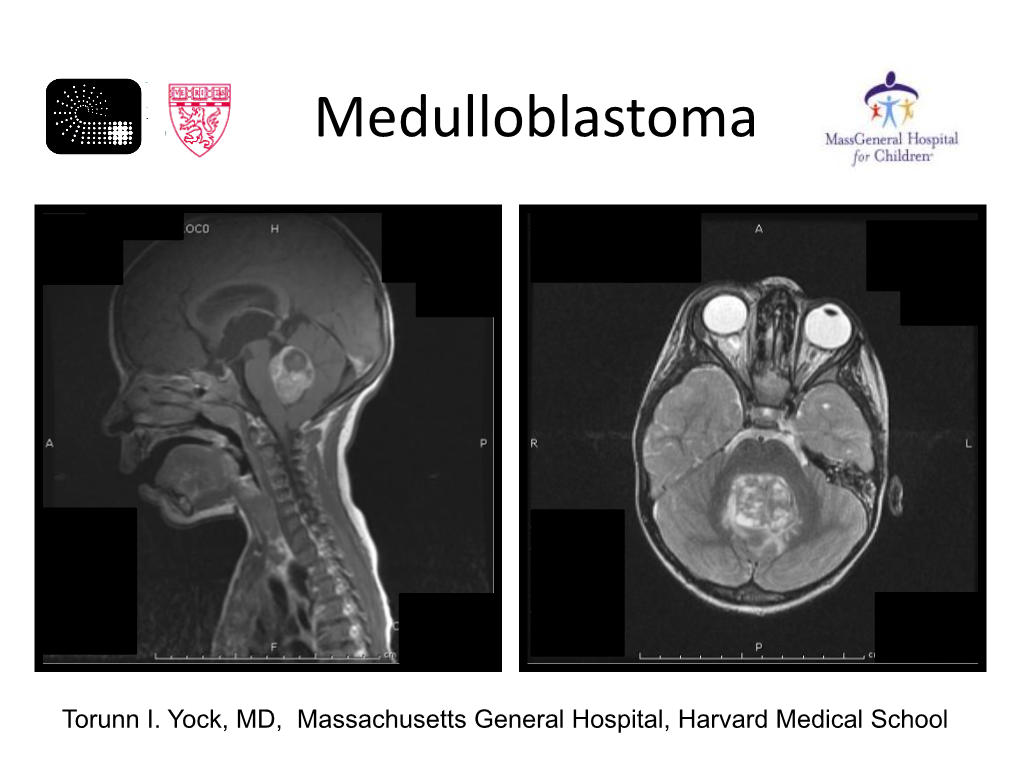 CNS Medulloblastoma