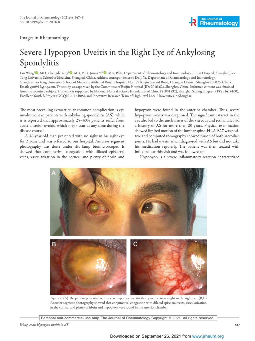 Severe Hypopyon Uveitis in the Right Eye of Ankylosing Spondylitis