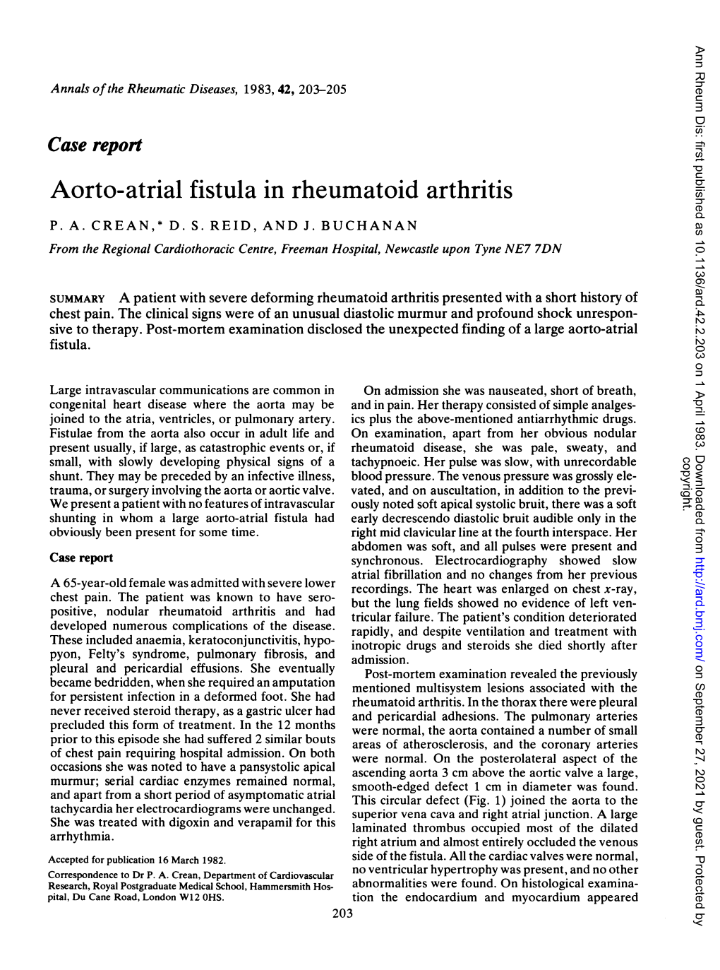 Aorto-Atrial Fistula in Rheumatoid Arthritis P