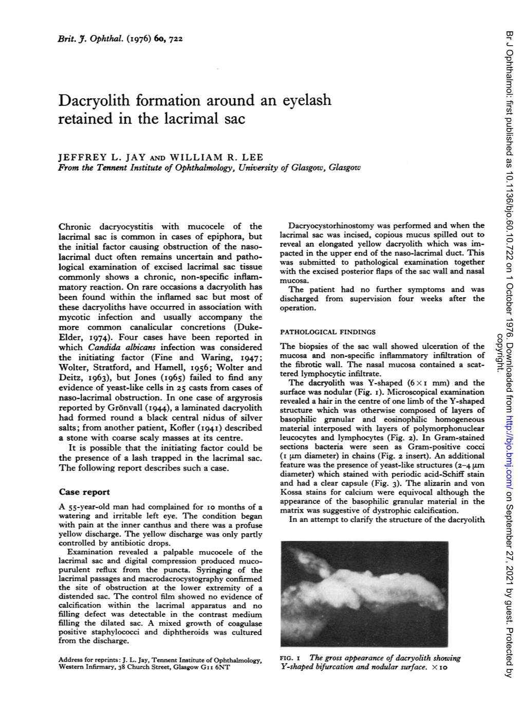 Dacryolith Formation Around an Eyelash Retained in the Lacrimal Sac