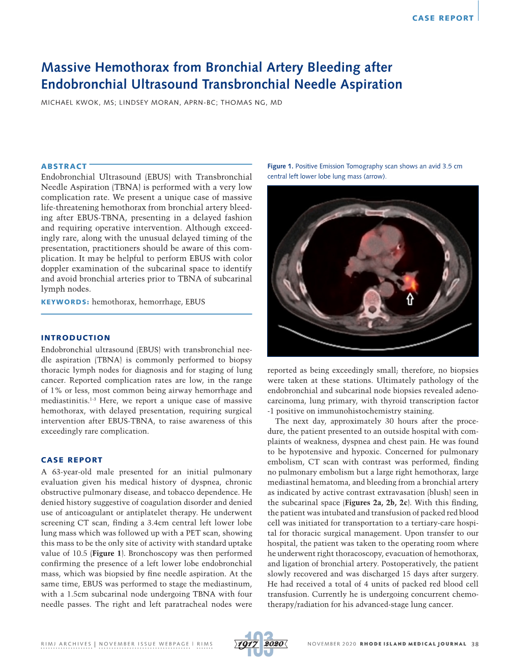 Massive Hemothorax from Bronchial Artery Bleeding After Endobronchial Ultrasound Transbronchial Needle Aspiration