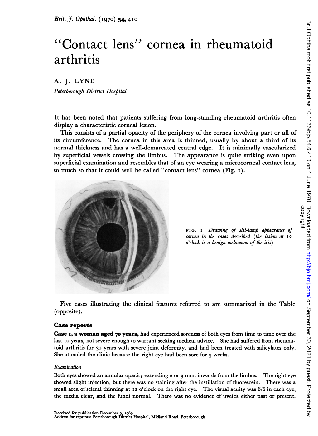 "Contact Lens" Cornea in Rheumatoid Arthritis