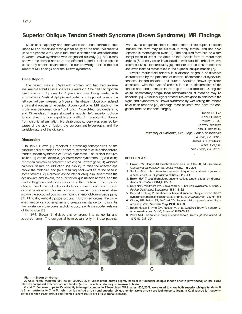 Superior Oblique Tendon Sheath Syndrome (Brown Syndrome): MR Findings